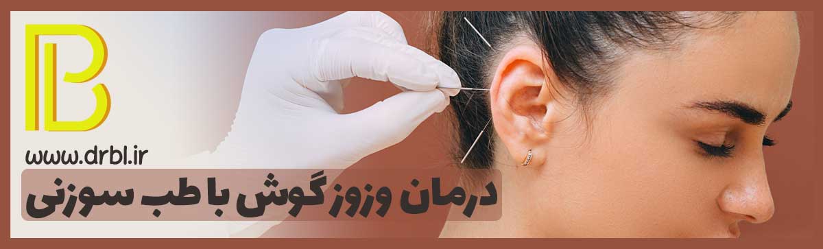 درمان وزوز گوش با طب سوزنی